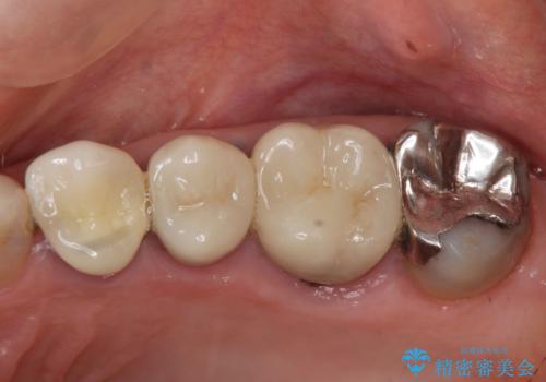 骨の造成を伴うインプラント治療の治療前