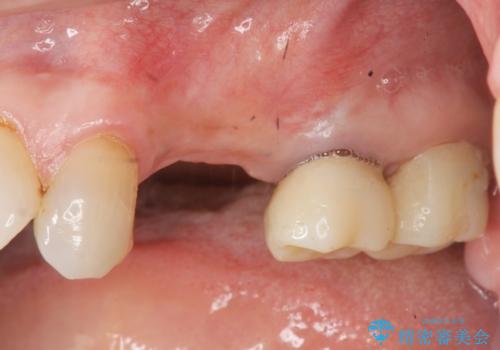骨の造成を伴うインプラント治療の治療中