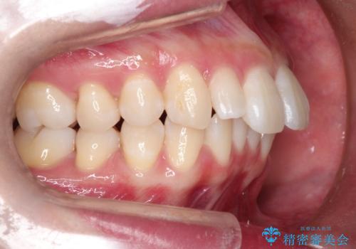 ワイヤー矯正とオールセラミックの組み合わせ治療の治療前