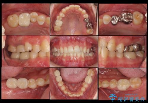 虫歯を放置 しっかり治療したい。 抜歯してインプラント治療の治療後