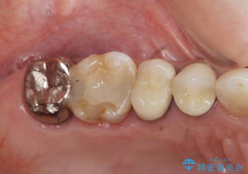 臼歯部メタルフリー再補綴の治療前