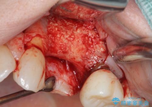 骨の造成を伴うインプラント治療の治療中