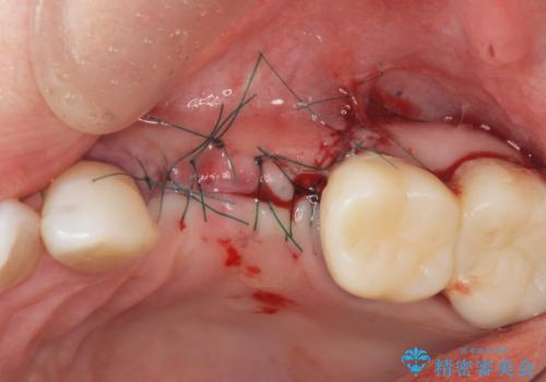 骨の造成を伴うインプラント治療の治療中