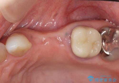 骨の造成を伴うインプラント治療の治療前