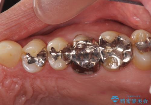 臼歯部インプラント・再補綴の治療前