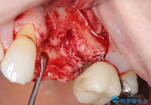 骨の造成を伴うインプラント治療の治療前