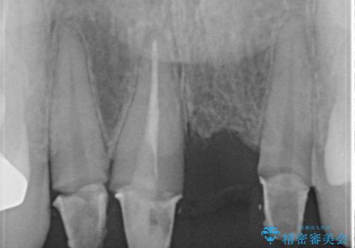 3年間仮歯 前歯セラミックブリッジの治療前