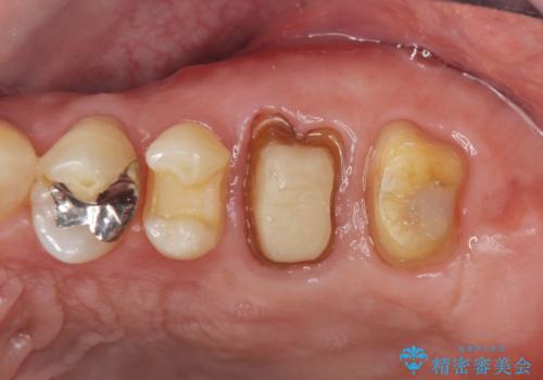 臼歯部インプラント・再補綴の治療中