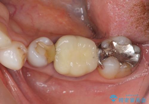 歯ぐきの腫れを改善する歯周外科手術を伴うセラミック治療の治療前
