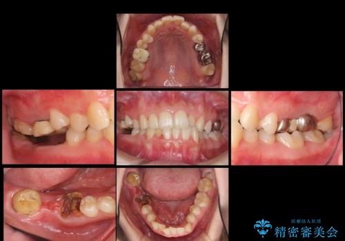 虫歯を放置 しっかり治療したい。 抜歯してインプラント治療の治療前
