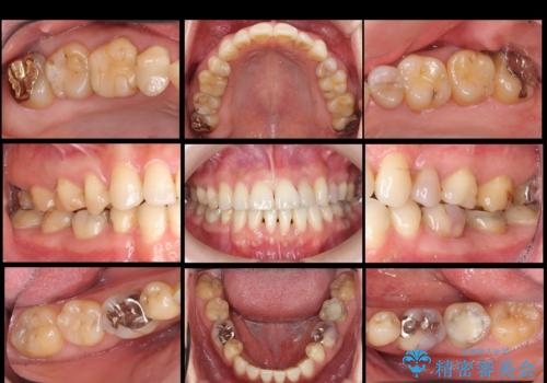 全体的な虫歯治療 の治療前