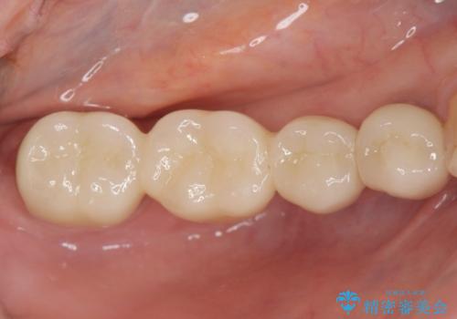 臼歯部メタルフリー再補綴の治療後