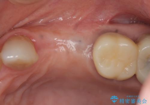 骨の造成を伴うインプラント治療の治療中