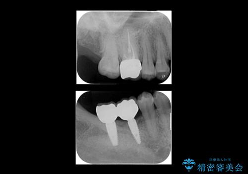 虫歯を放置 しっかり治療したい。 抜歯してインプラント治療の治療後