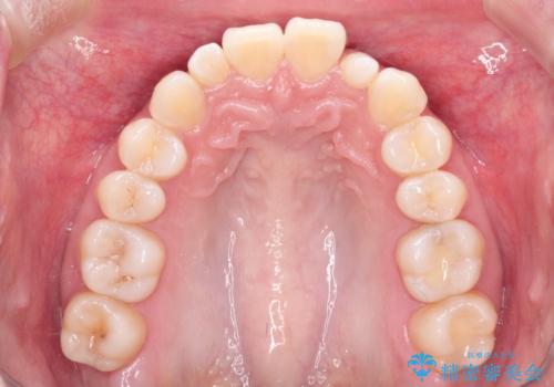 ワイヤー矯正とオールセラミックの組み合わせ治療の治療前