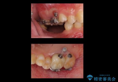 虫歯を放置 しっかり治療したい。 抜歯してインプラント治療の治療中
