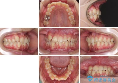 八重歯で正中が右にずれている ワイヤー装置での抜歯矯正で正中位置を改善の治療前