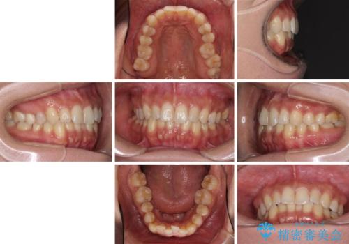 沖縄から飛行機で通院 インビザラインによる矯正治療の治療前
