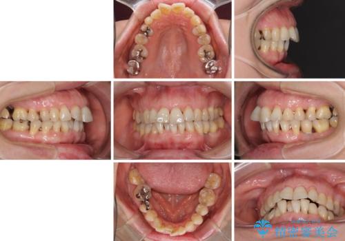 口元の出っ張りとデコボコを改善したいの治療前
