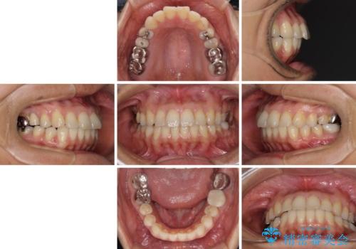 痛む奥歯と矯正の後戻り インビザライン・ライトとセラミック治療の治療前