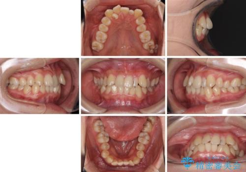 八重歯の抜歯矯正 補助装置を用いたインビザライン矯正の治療前