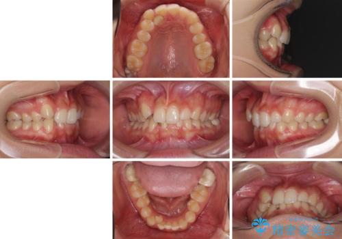 気になる八重歯を改善 補助装置併用のインビザライン治療の治療前