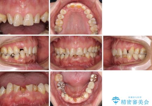 乳歯や矮小歯の多い前歯 部分矯正と補綴治療による審美歯科治療の治療前