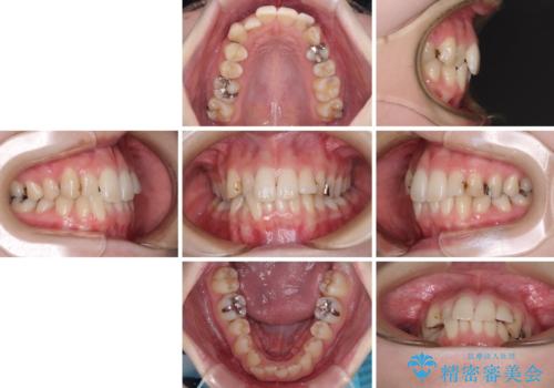 短期間での治療 急速拡大装置を併用したワイヤー装置による矯正治療の治療前