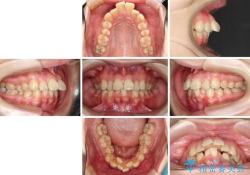 飛び出した前歯を引っ込めたい 目立たないワイヤーでの抜歯矯正の治療前