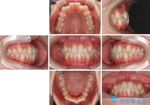 ワイヤー矯正を併用し、リスクを回避しながらのインビザライン矯正治療の治療前