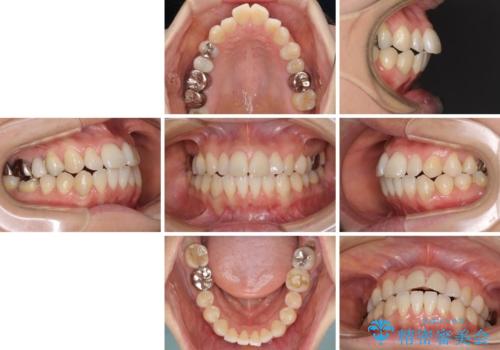 気になる前歯をインビザライン・ライトで 矯正治療後には銀歯をセラミックにの治療前