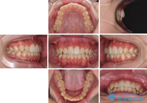 しっかり使って短期間で治療 インビザラインによる叢生解消の治療前