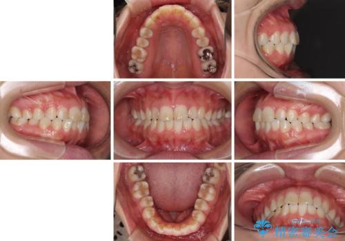 気になる前歯を治したい インビザラインで気づかれずに矯正治療の治療前