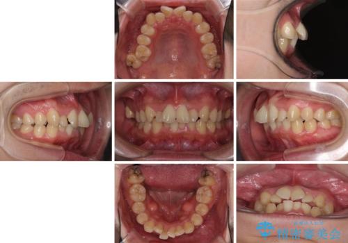強い咬み込みですり減った前歯 デコボコを抜歯矯正で整えるの治療前