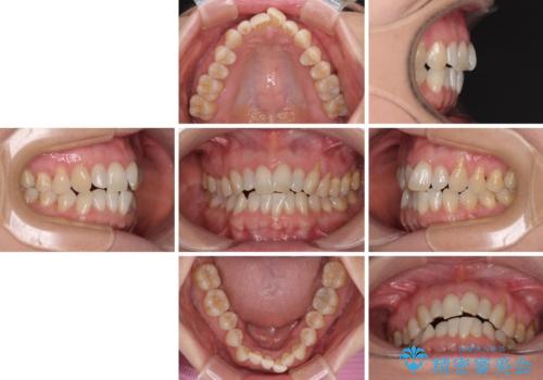 前歯のスペースが気になる　インビザラインによる矯正治療の治療前