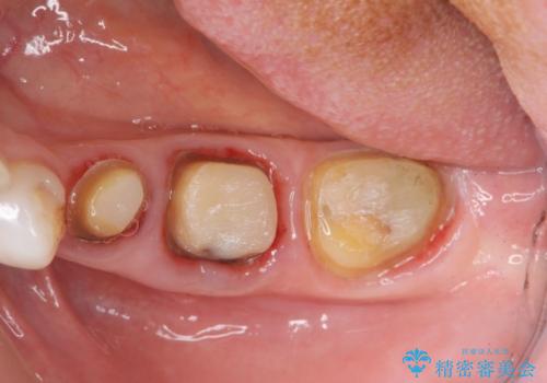 歯ぐきの腫れを改善する歯周外科手術を伴うセラミック治療の治療前