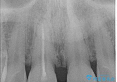 【前歯の被せ物】オールセラミッククラウン(エクセレント)の治療前