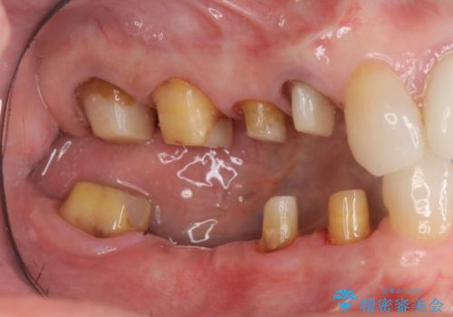 臼歯部メタルフリー再補綴の治療中