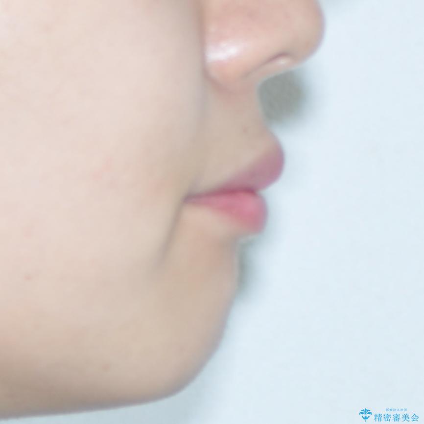 飛び出した前歯を引っ込めたい 目立たないワイヤーでの抜歯矯正の治療前(顔貌)