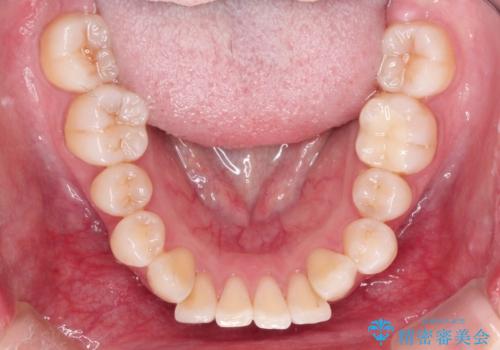 ワイヤー矯正とオールセラミックの組み合わせ治療の治療前