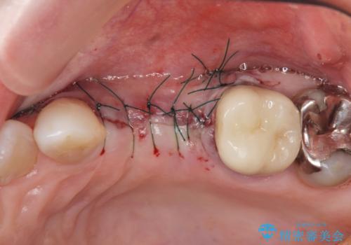 骨の造成を伴うインプラント治療の治療前