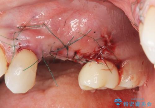 骨の造成を伴うインプラント治療の治療中