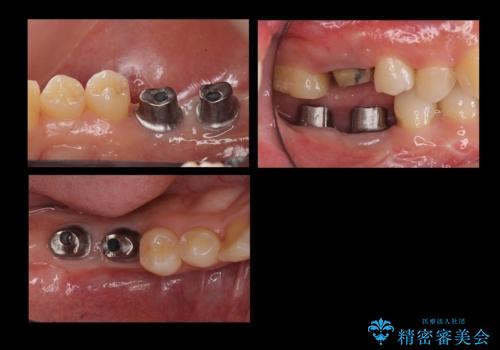 虫歯を放置 しっかり治療したい。 抜歯してインプラント治療の治療中