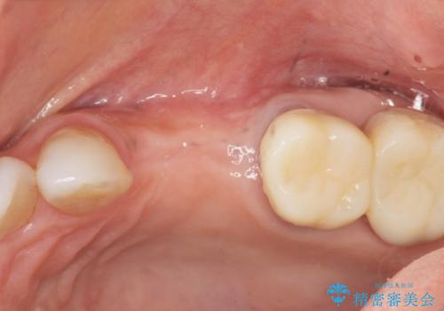 骨の造成を伴うインプラント治療の治療中