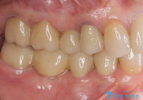 臼歯部メタルフリー再補綴の症例 治療後