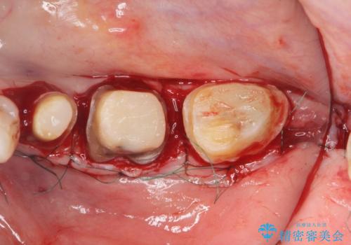 歯ぐきの腫れを改善する歯周外科手術を伴うセラミック治療の治療前