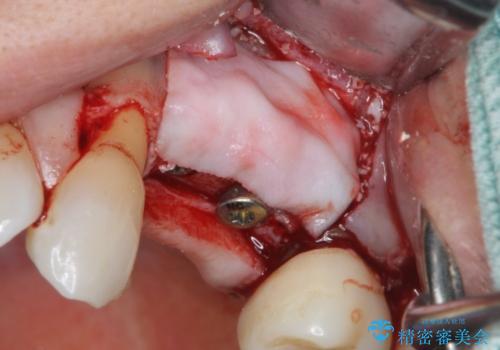 骨の造成を伴うインプラント治療の治療中