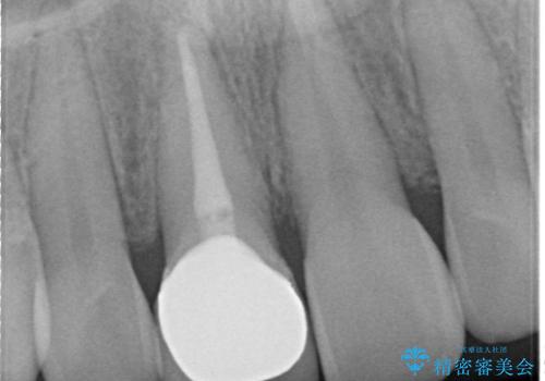 【前歯の被せ物】オールセラミッククラウン(エクセレント)の治療後