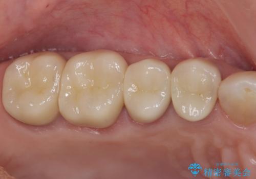 臼歯部メタルフリー再補綴の治療後