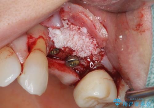 骨の造成を伴うインプラント治療の治療中